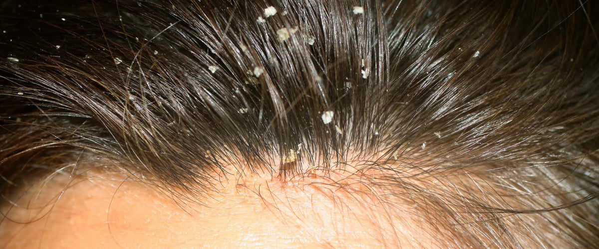 Seborrheea What is Seborrhea and how to prevent?